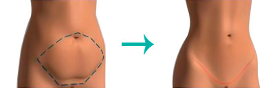 Tipos-de-Abdominoplastia-(TAC)_classica