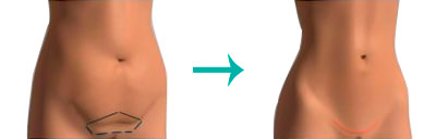 Tipos-de-Abdominoplastia-(TAC)_mini