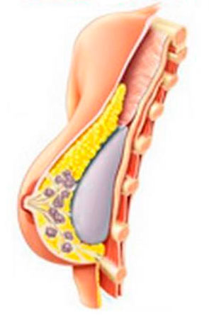 Tecnicas-de-Implantacao-de-Proteses-de-Silicone-(TAC)_subfascial