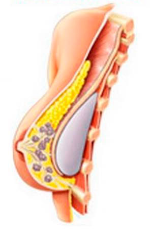 Tecnicas-de-Implantacao-de-Proteses-de-Silicone-(TAC)_submuscular