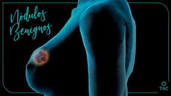 Nódulos benignos e câncer de mama: dicas do especialista